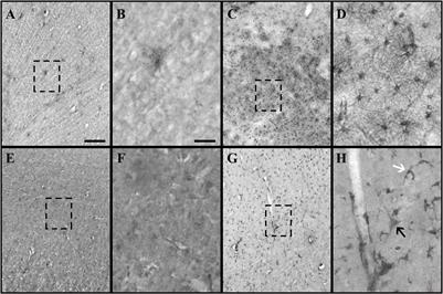 Crystallin Alpha-B Overexpression as a Possible Marker of Reactive Astrogliosis in Human Cerebral Contusions